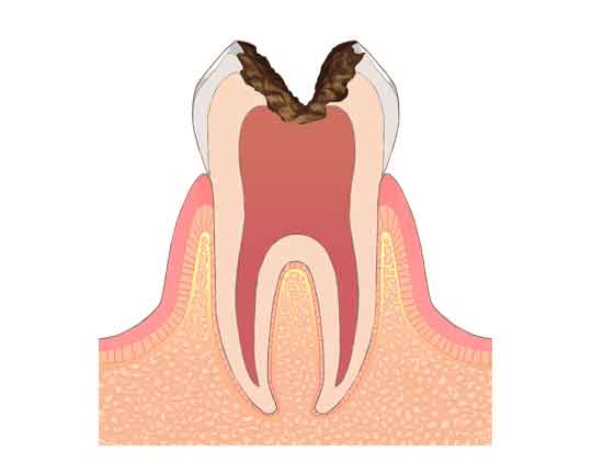 神経に及ぶ虫歯